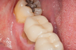 Close Up of Gum Disease