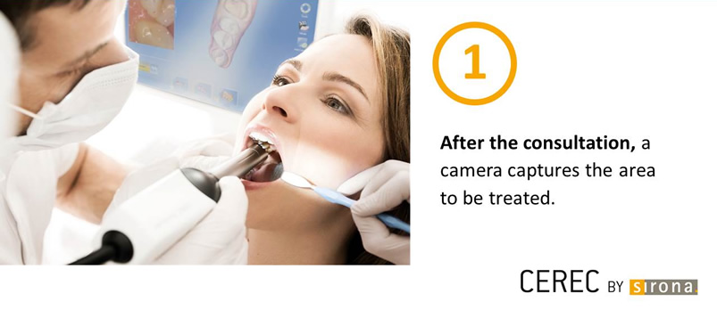 Same Day Dental Crowns Step 1