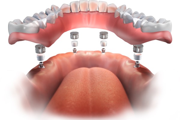 Smile Makeover Treatment: All On  ®