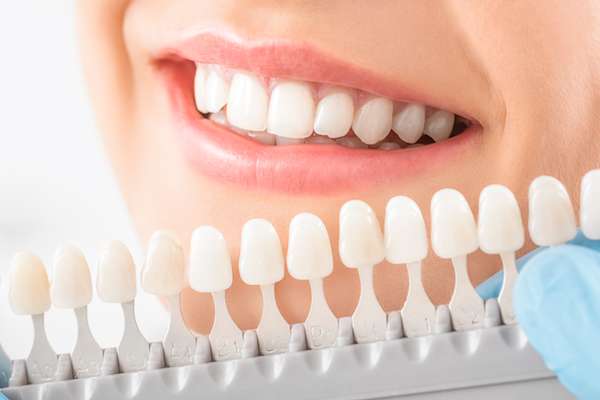 Important Differences Between Composite And Porcelain Dental Veneers