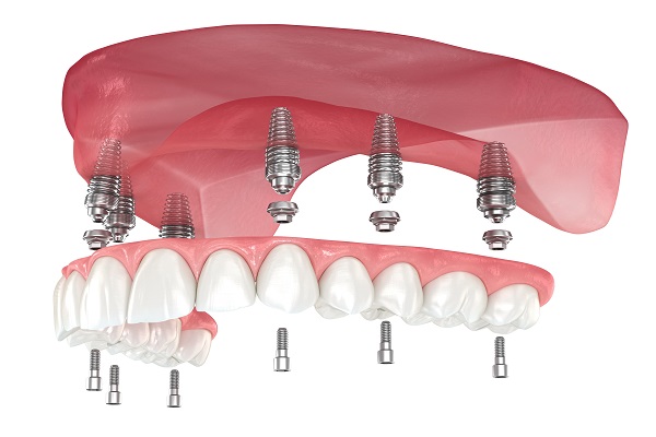 Care Tips For Implant Supported Dentures